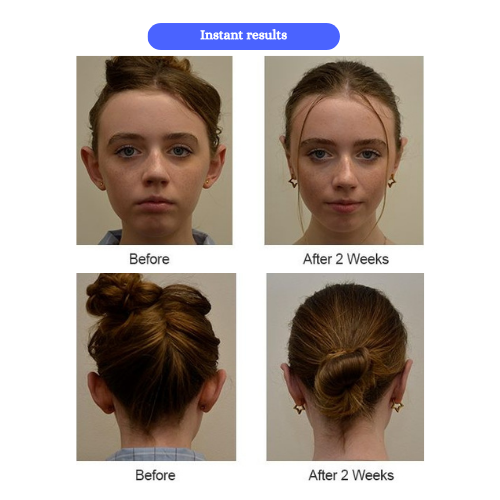 PerfectFit Ear Correctors