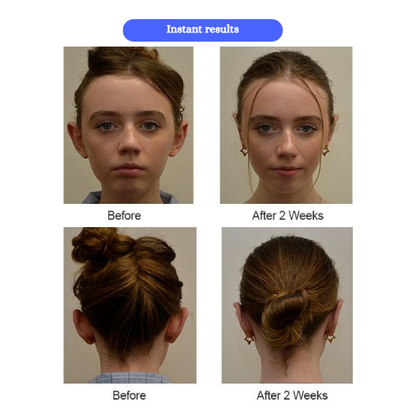 PerfectFit Ear Correctors